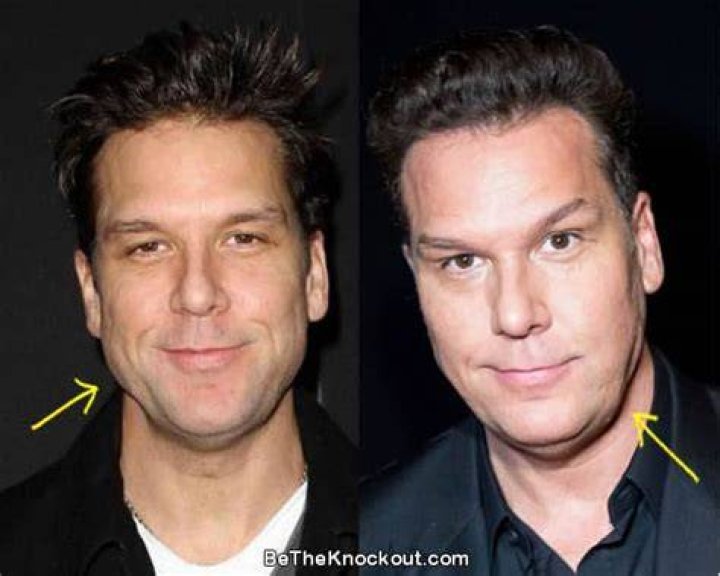 dane cook botox