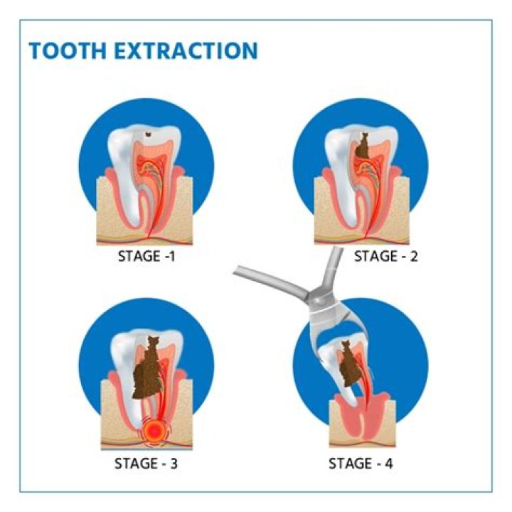 tooth extraction procedure