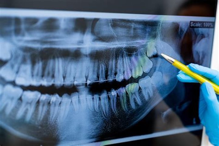 X-rays for extraction